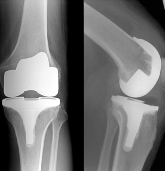 Arthritis & knee replacement Archives Dr. Bu Balalla